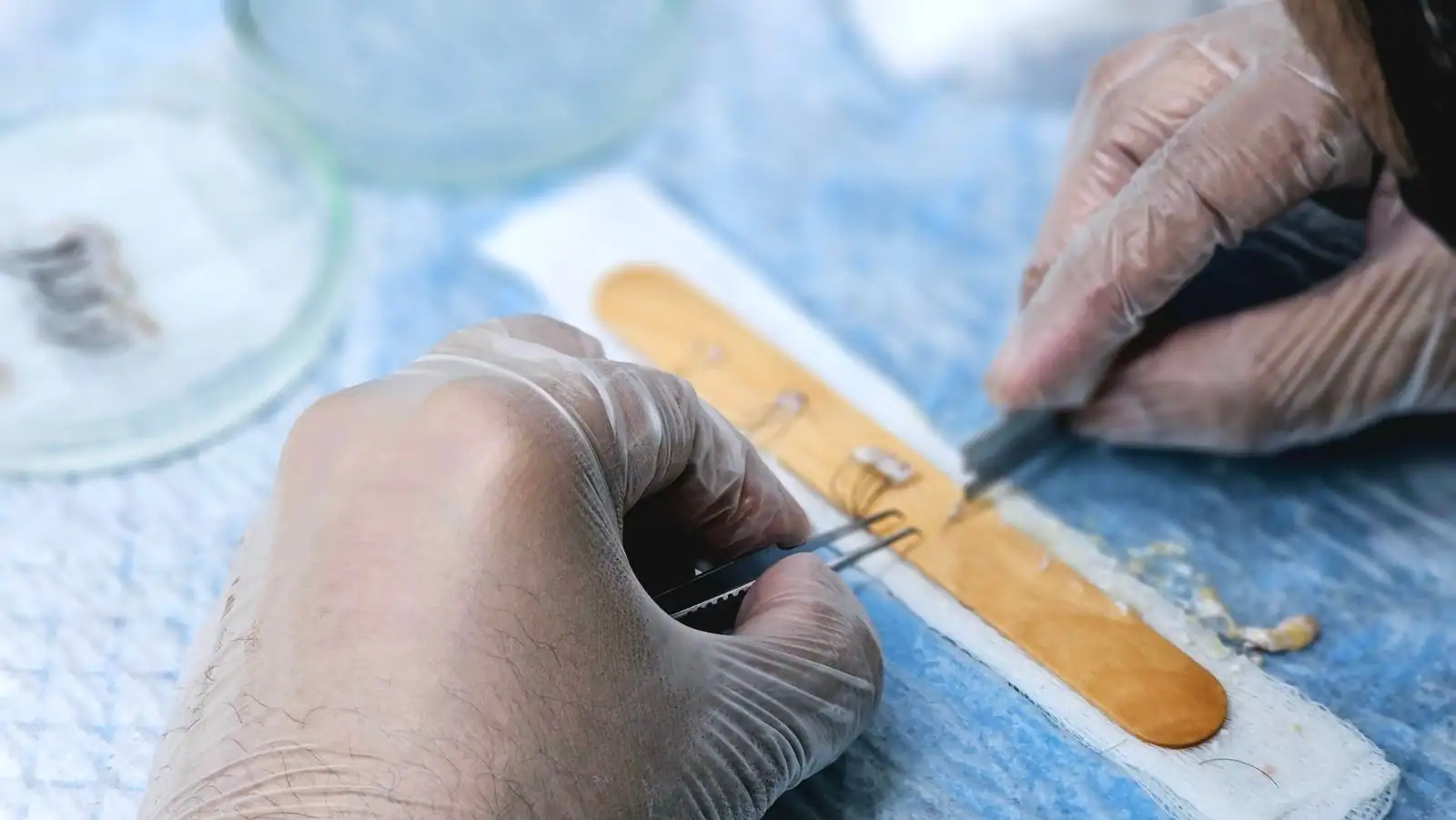 Préparation des greffons : les unités folliculaires sont séparées une à une avant la réimplantation
